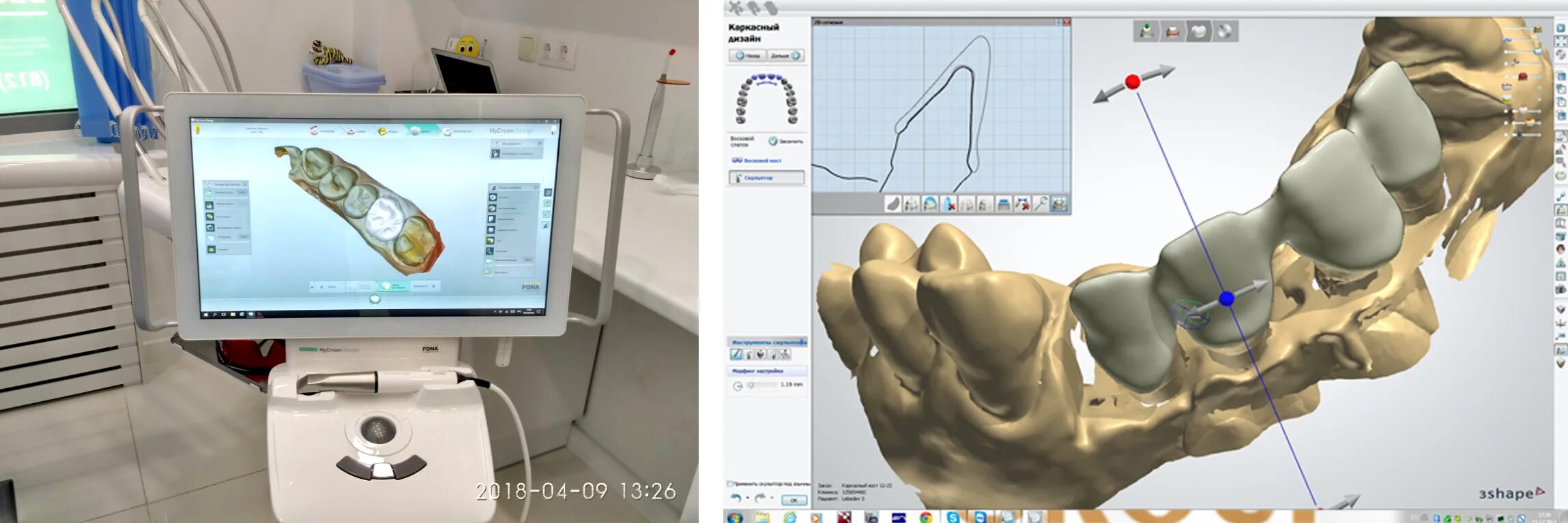 Ис кам. КАД Кам системы в стоматологии. CAD-cam система цифровой оттиск. CAD cam технологии в ортопедической стоматологии. CAD/cam цифровой оттиск в стоматологии.