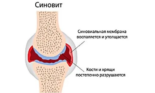 Синовит синовиальная оболочка. Утолщение синовиальной оболочки. Супрапателлярный синовит. Вторичный реактивный синовит.