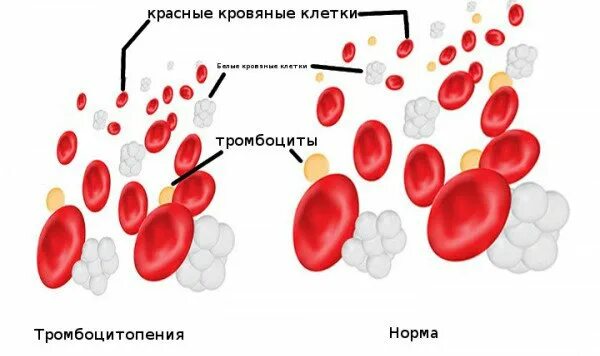 Как понизить тромбоциты. Тромбоциты. заболевания тромбоцитов.