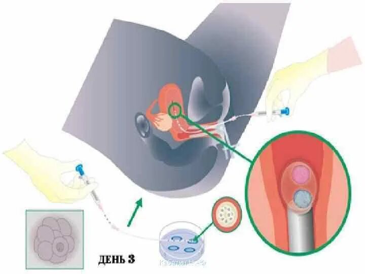 Как происходит криоперенос. Перенос эмбриона в матку при эко. Криоперенос эмбриона в матку. Эко подсаживают эмбрион.
