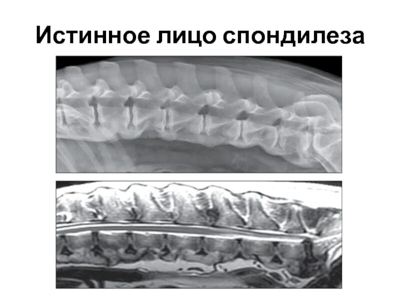 Спондилёз поясничного отдела позвоночника рентген. Деформирующий спондилез. Спондилёз шейного отдела позвоночника что это такое. Спондилез на кт. Начальный спондилез