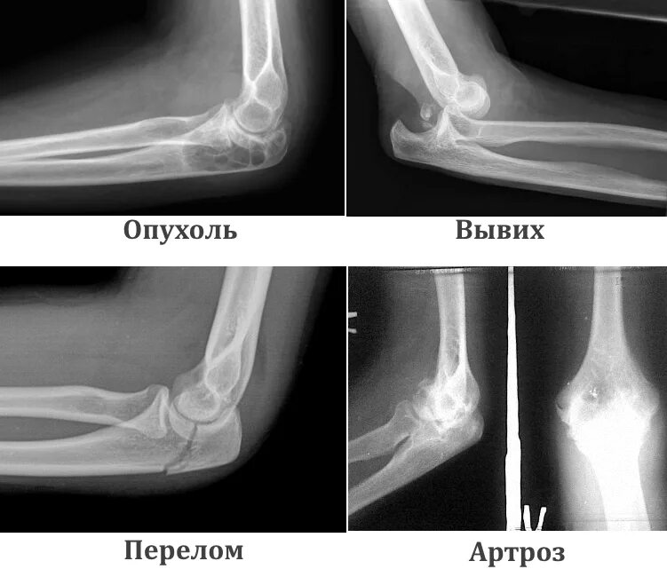 Как определить трещину в кости. Рентгенограмма перелом локтевой сустав. Патология локтевого сустава рентген. Подвывих локтевого сустава рентген. Травма локтевого сустава рентген.