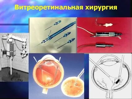 Витрэктомия