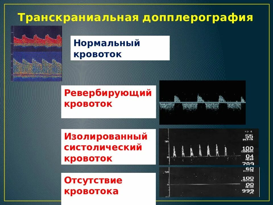 Транскраниальных артерий и вен. Транскраниальная допплерография. Транскраниальная допплерография при смерти мозга. Транскраниальная ультразвуковая допплерография. Допплерография кровотока.