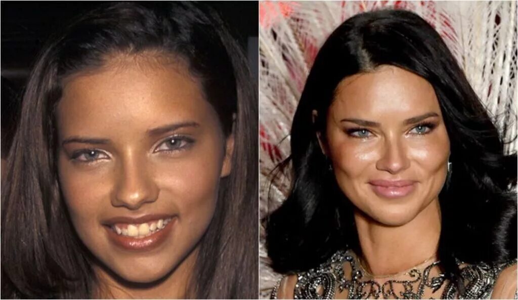 Pin by None Ya on Celeberties Surgery & Make up Plastic surgery, Adriana lima, S