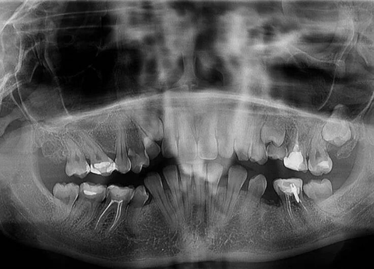 Снимок зубов видное. Эктодермальная дисплазия зубы. Ортопантомограмма челюсти.