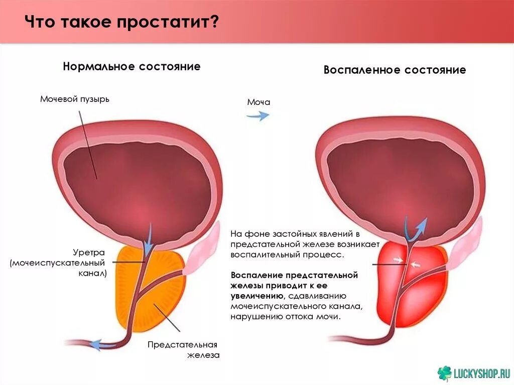 Простата что это такое. Простата что это такое. Простата что это такое. Аденома простаты у мужчин фото. Простата что это такое.