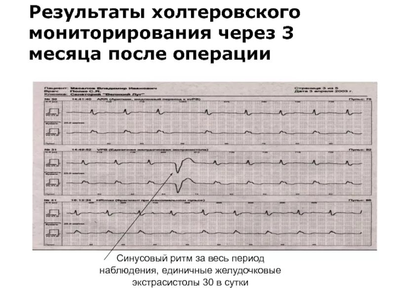 Наджелудочковая экстрасистолия Холтер. Желудочковая экстрасистолия норма на Холтере. Холтеровское мониторирование - наджелудочковая экстрасистолия. Экстрасистолы на Холтере. Норма экстрасистол в сутки по холтеру