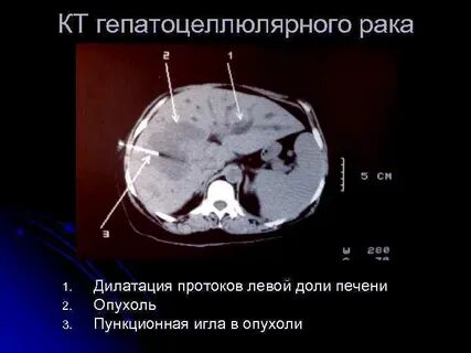 Гепатоцеллюлярный рак печени