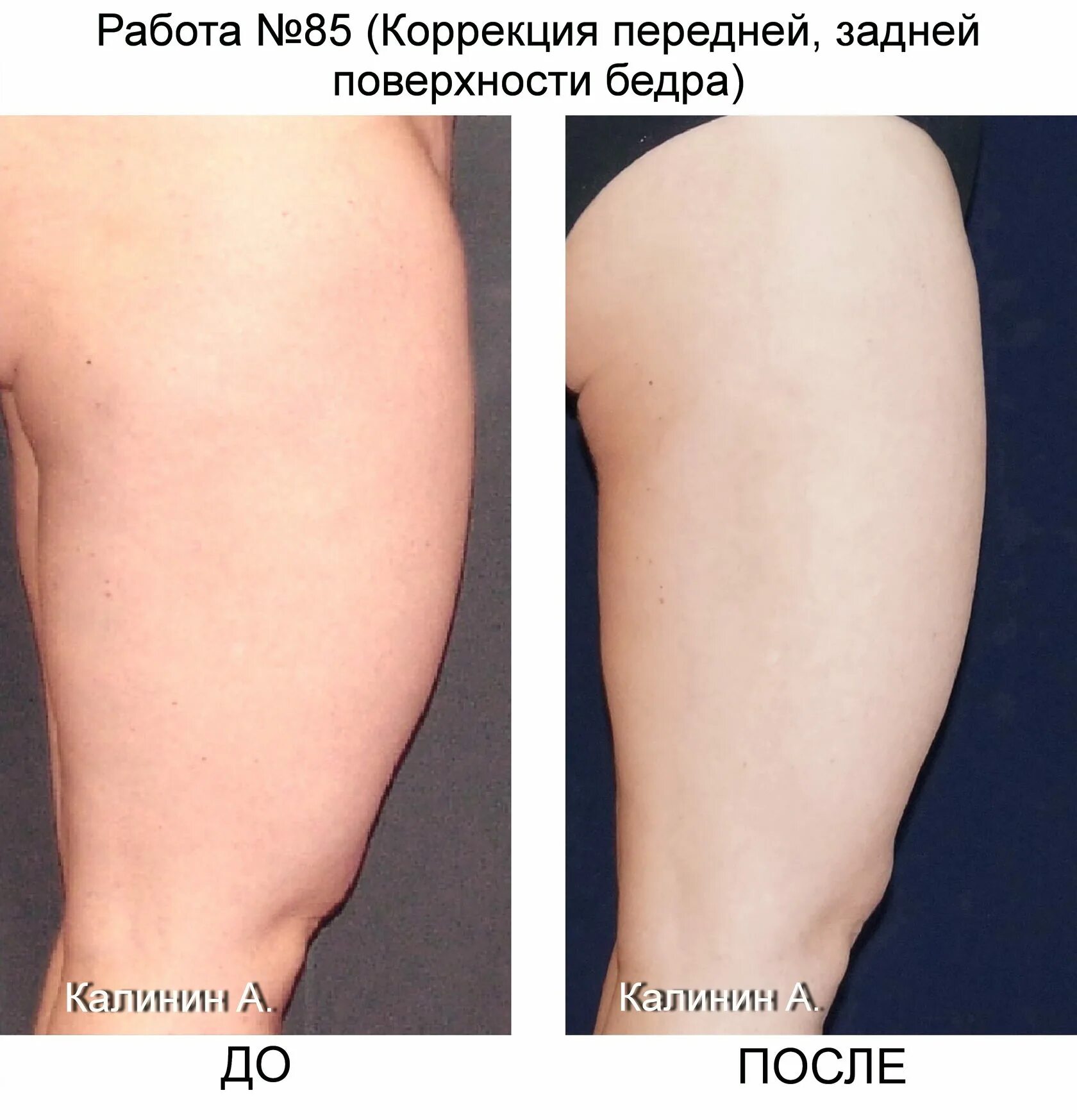 Почему после задней. Задняя поверхность бедра. передняя поверхность бедра. жир на задней поверхности бедра. жир на передней поверхности бедра.