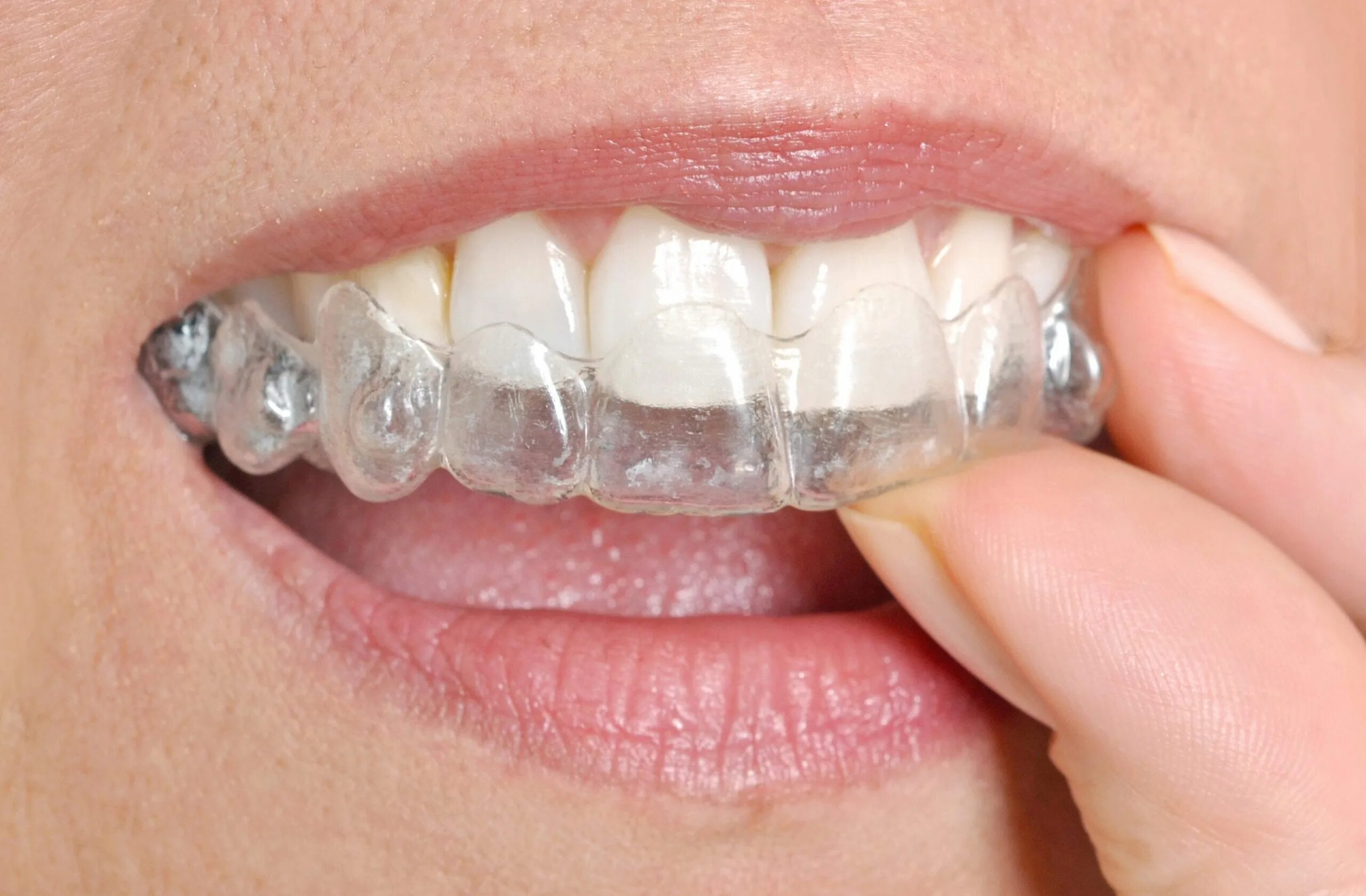 Invisalign. Каппы элайнеры. элайнеры invisalign. элайнеры инвизилайн.