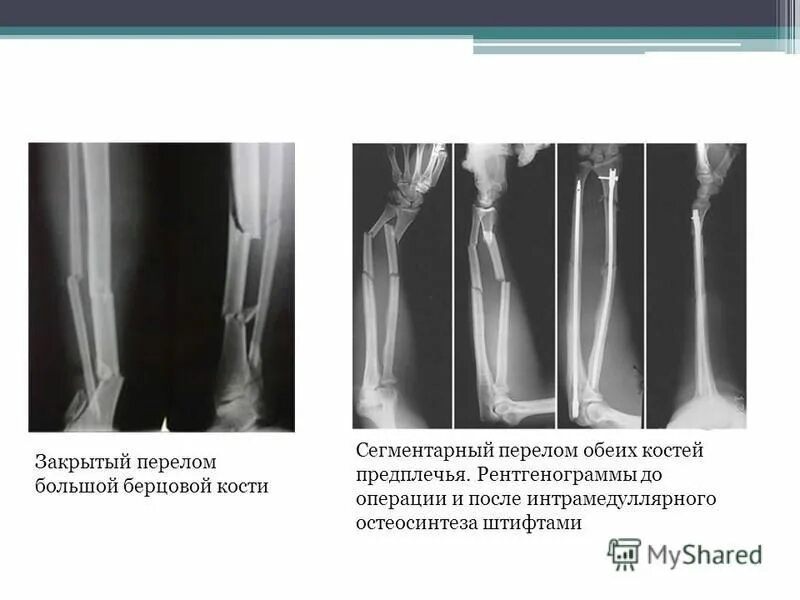 перелом метафиза малоберцовой кости. перелом обеих берцовых костей. винтовой перелом большеберцовой кости. переломы диафиза костей голени классификация.
