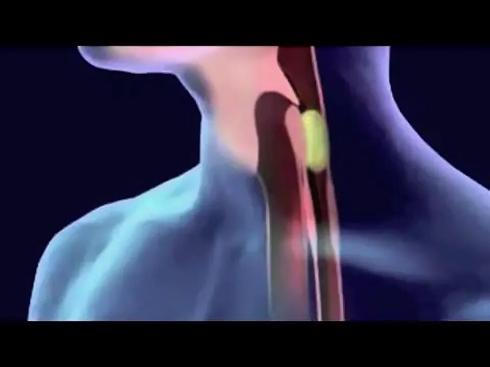 Повышенная глотания