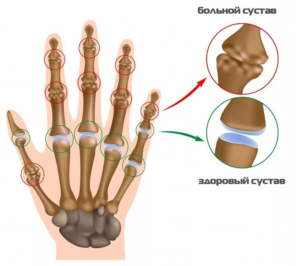 Суставы пальцев сильно. Ревматоидный артрит кисти. Артрит межфаланговых суставов кисти. Артроз межфаланговых суставов. Суставы пальцев рук анатомия.