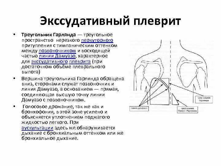 Положение при плеврите. Положение при плеврите