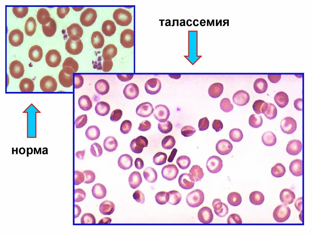 Эритроциты шизоциты. Клетки крови человека лимфоциты. Эритроциты мазок норма. Нормальные эритроциты мазок. Альфа талассемия картина крови.
