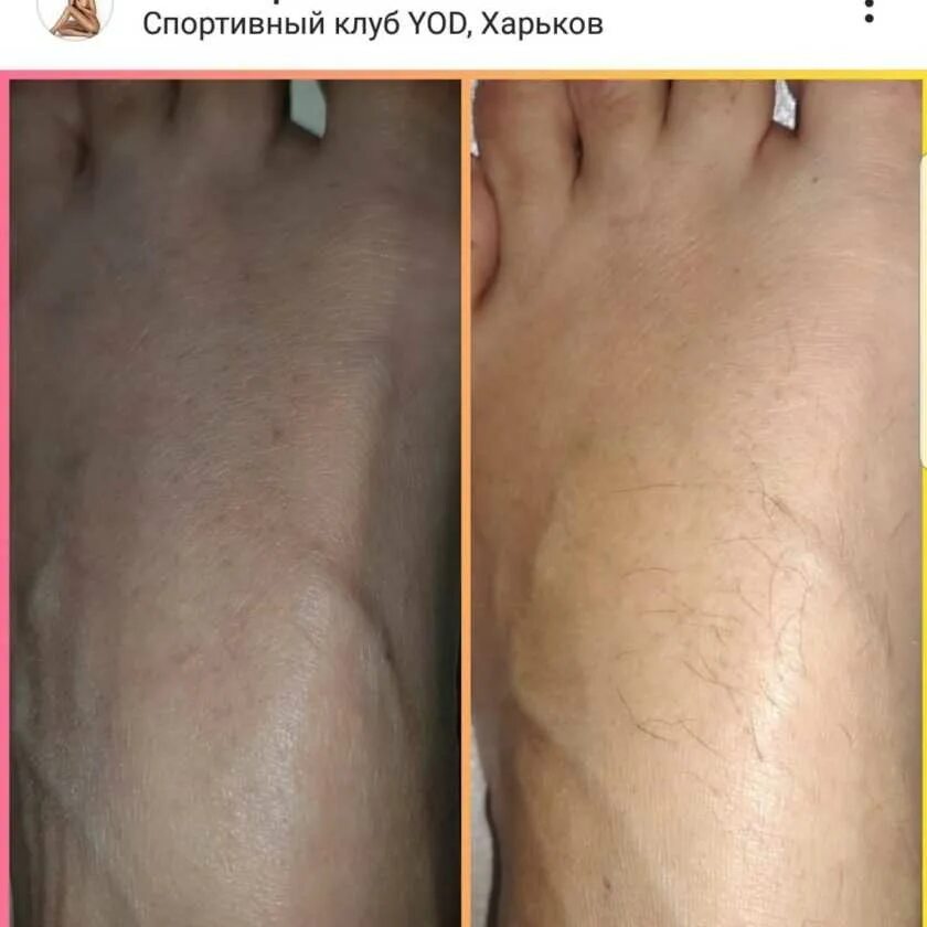 Почему нельзя делать лазерную эпиляцию