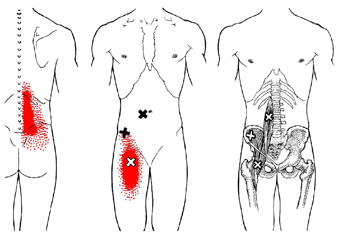 Триггерные точки мышц бедра боль. Триггерные точки в мышцах спины. Триггерные точки ППМ. Триггерные точки на животе.