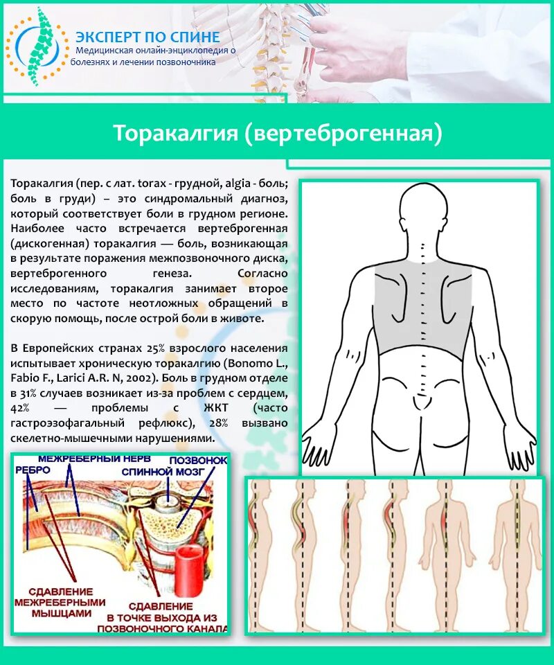 Торакалгия что это за диагноз лечение. Вертиброгенная торкалия. Верте.рогенная тораклагия. Вертеброгенная торакалгия. Торакалгия грудного отдела.