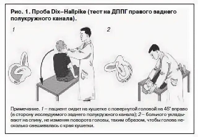 Проба холпайка. Пробы при ДППГ. ДППГ проба Дикса-Холпайка. Маневр Дикса Холпайка. Проба Дикса Холпайка при ДППГ.