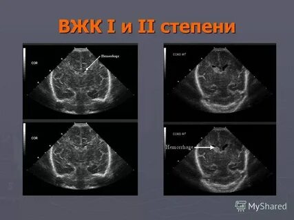 Кровоизлияние у детей