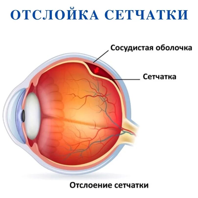 Отслойка сосудистой оболочки глаза. Отслойка сетчатки строение глаза. Сосудистая оболочка глазного яблока строение. Функции сетчатки оболочки глазного яблока.