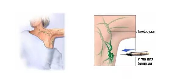 Лимфогранулематоз подмышкой. Аксиллярная лимфаденопатия молочной. Биопсия лимфатических узлов при лимфаденопатии. Жидкость в лимфоузле