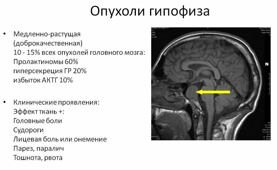 Гипофиз лечение. Опухоль аденома гипофиза. Опухоли гипофиза Макропрепараты. Пролактинома гипофиза мрт. Опухоли передней доли гипофиза патологическая анатомия.