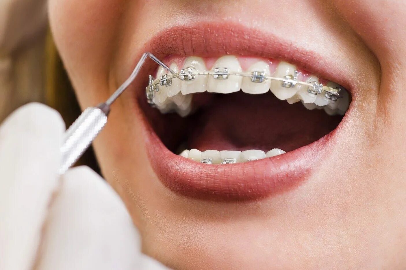 Ортодонтия в стоматологии. Стоматология брекеты. Стоматология ортодонт. Брекет система. Установка брекетов люберцы