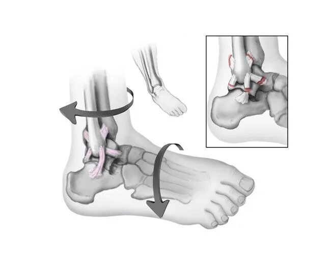 Перелом голеностопного сустава. Операция разрыв связок голеностопа. Перелом голеностопа с вывихом. Тургор на голеностопный сустав. Растяжение связок голеностопа операция.