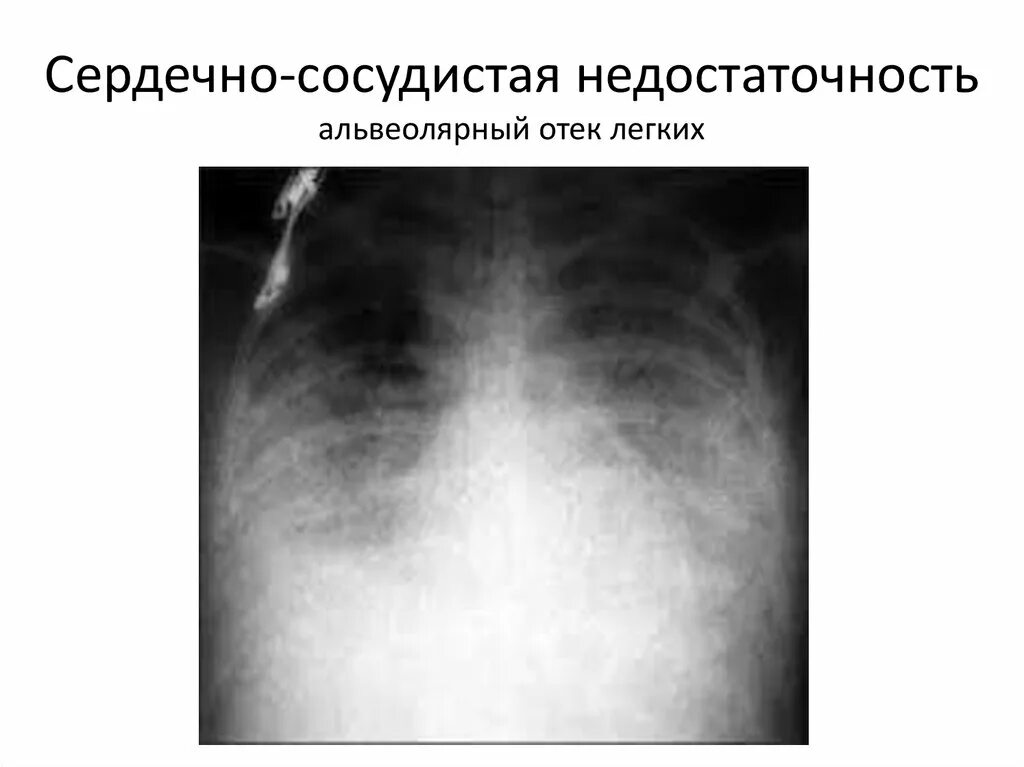 Отек легких жидкость. Гидроторакс при сердечной недостаточности. Рентген при сердечной недостаточности. Острая сердечная недостаточность отек легких.