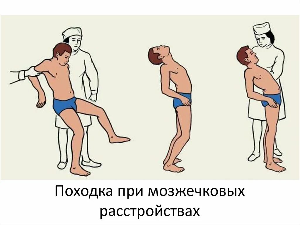 Виды нарушения координации