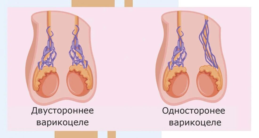 Расширение вен канатика. Варикозное расширение левого яичка. Расширение вен семенного канатика.