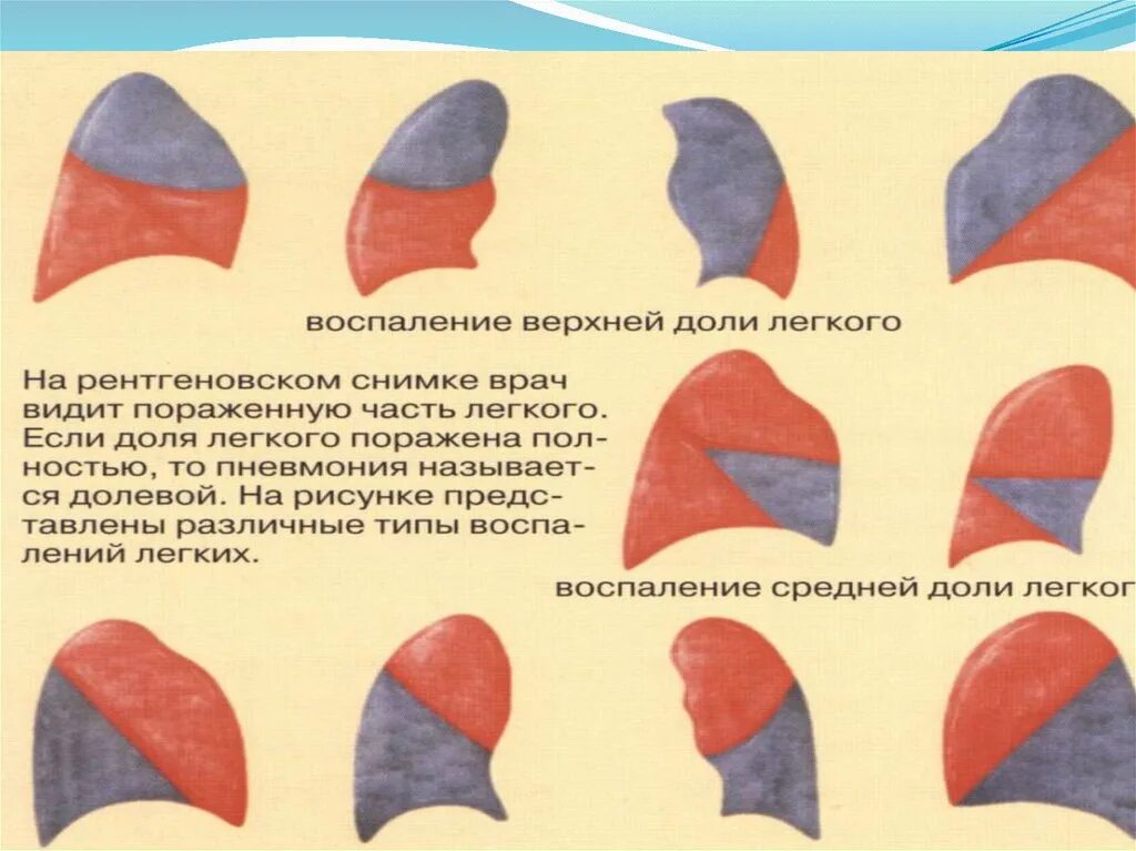 Изменения в верхней доле легкого. Крупозная пневмония схема. Воспаление доли легкого. Воспаление целой доли легкого. Пневмония верхней доли.