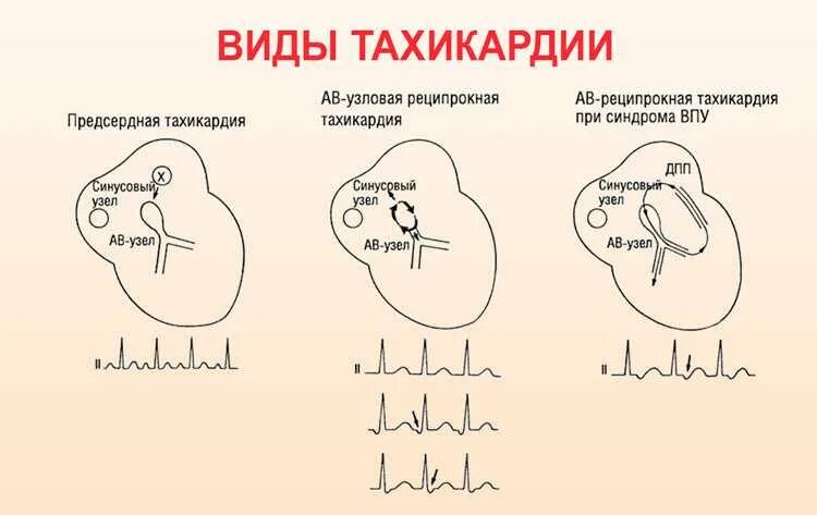 Тахикардия симптомы лечение у взрослых. Тахикардия. виды тахикардии. учащенное сердцебиение. тахикардия сердца.