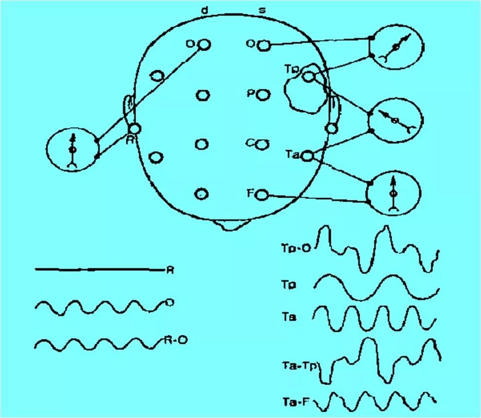 ЭЭГ наложение электродов схема 10-20. Схема наложения электродов ЭЭГ. ЭЭГ отведения 10-20. Схема 10-20 наложение электродов.