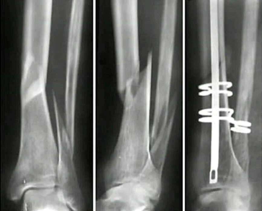 Перелом берцовой кости рентген. Оскольчатый перелом малоберцовой кости рентген. Винтообразный перелом рентген. Винтообразный перелом большеберцовой кости рентген. Операция малоберцовой кости
