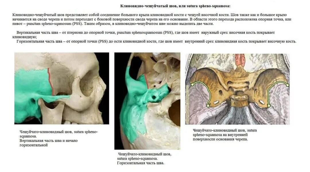 Клиновидная кость черепа. Клиновидно чешуйчатый. Спинка седла клиновидной кости. Клиновидная кость препарат. Дисплазия крыла клиновидной кости.