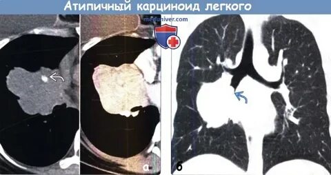 Карциноид легкого