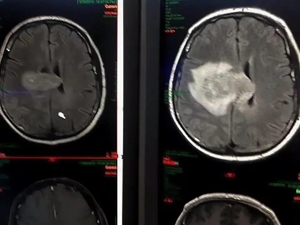 Отек мозга код. Опухоль головного мозга уменьшилась. Уменьшение опухоли flot. Уз дезинтегратор опухоли мозга.