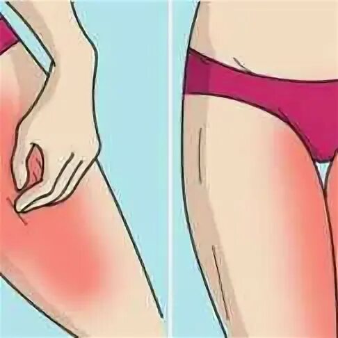 Худые ляжки. Капроновые шорты. Натертость на внутренней стороне бедра. Узловатая эритема на голени. Ноги во всю длину.