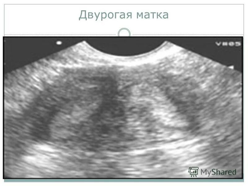 Как выглядит двурогая матка. Аномалии строения матки. Uterus bicornis — двурогая матка,. Как выглядит двурогая матка. Как выглядит двурогая матка.