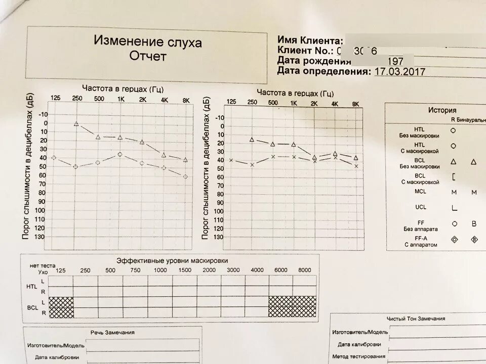 Аудиограмма степени. Аудиограмма 1 степени тугоухости. Нейросенсорная тугоухость 1 степени аудиограмма. Аудиограмма при смешанной тугоухости 2 степени. Кондуктивная тугоухость 1 степени аудиограмма.