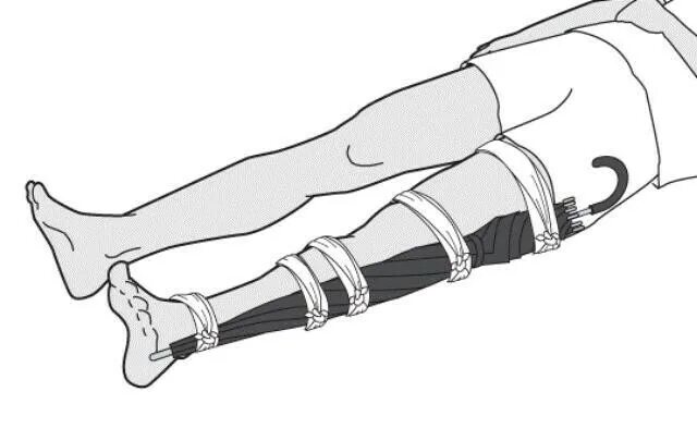 Наложение жгута при открытом переломе. При открытом переломе голени шина накладывается. ПМП при переломе голени. Открытый перелом бедра ПМП.