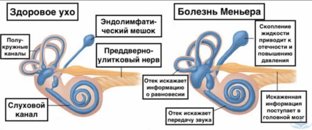 Вестибулярный аппарат симптомы у взрослых. Болезни внутреннего уха Меньера. Болезнь Меньера причины возникновения. Болезнь Меньера патогенез. Фунг при болезни Меньера.