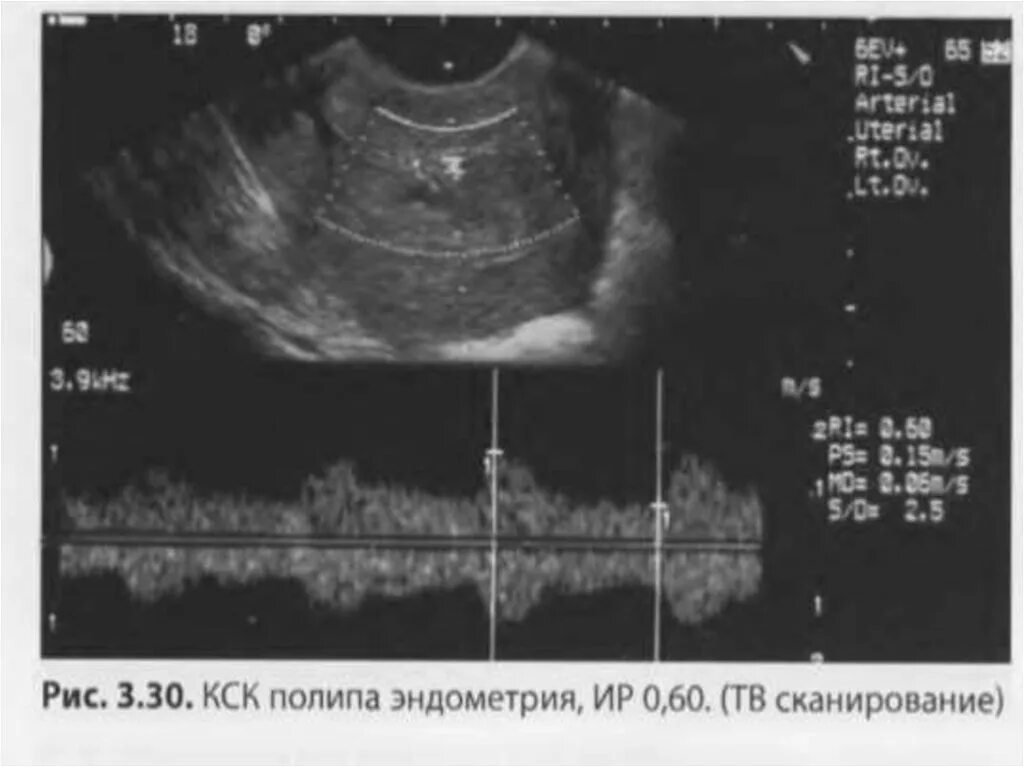 Гипопластического эндометрия. Эндометрий УЗИ гиперплазия. Гиперплазия эндометрия матки на УЗИ. Гиперплазия эндометрия УЗИ критерии.