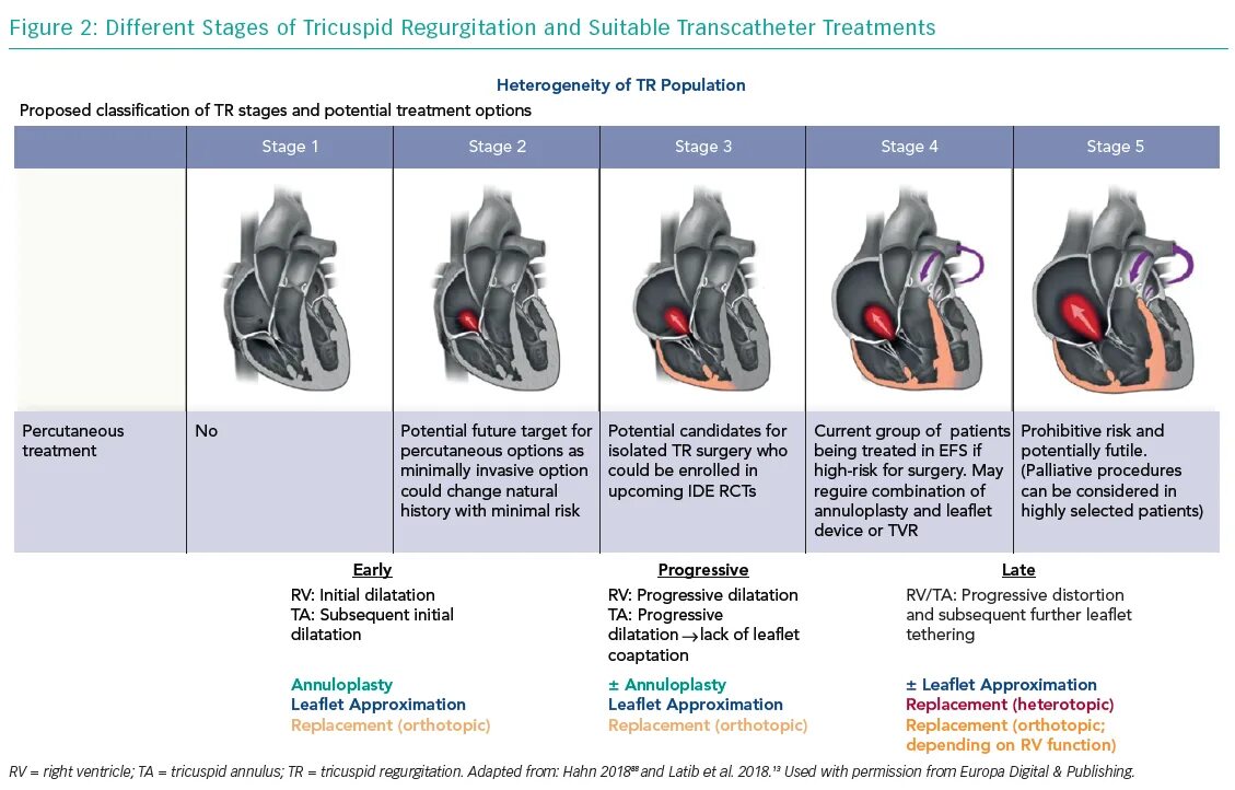 Tricuspid regurgitation. Tricuspid Valve Stenosis classification. Mitral tricuspid regurgitation. Different stages