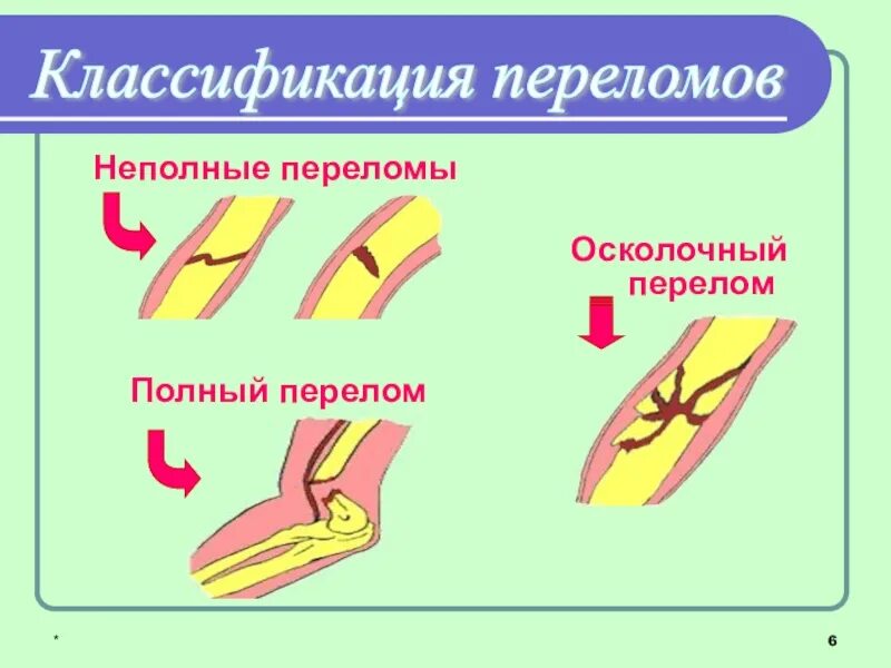 Типы закрытых переломов. Полный и неполный перелом. Полный и не полный передом. Полные и не полнеые переломы. Неполный закрытый перелом.