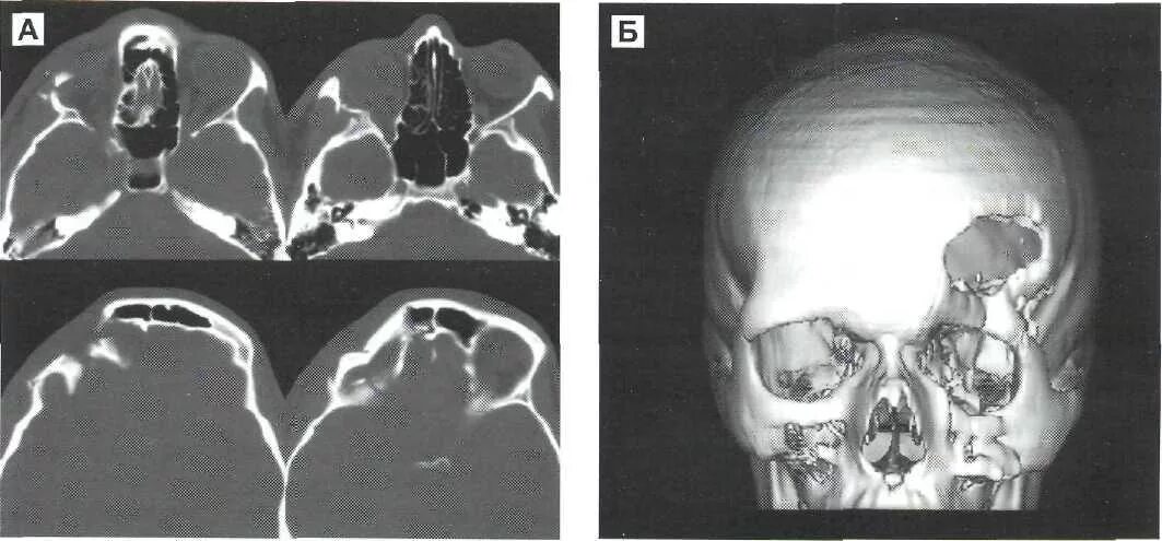 Опухоли лобной части. Вдавленный перелом лобной кости рентген. Перелом основания черепа на кт. Вдавленный перелом лобной кости кт. Перелом носовой кости кт.