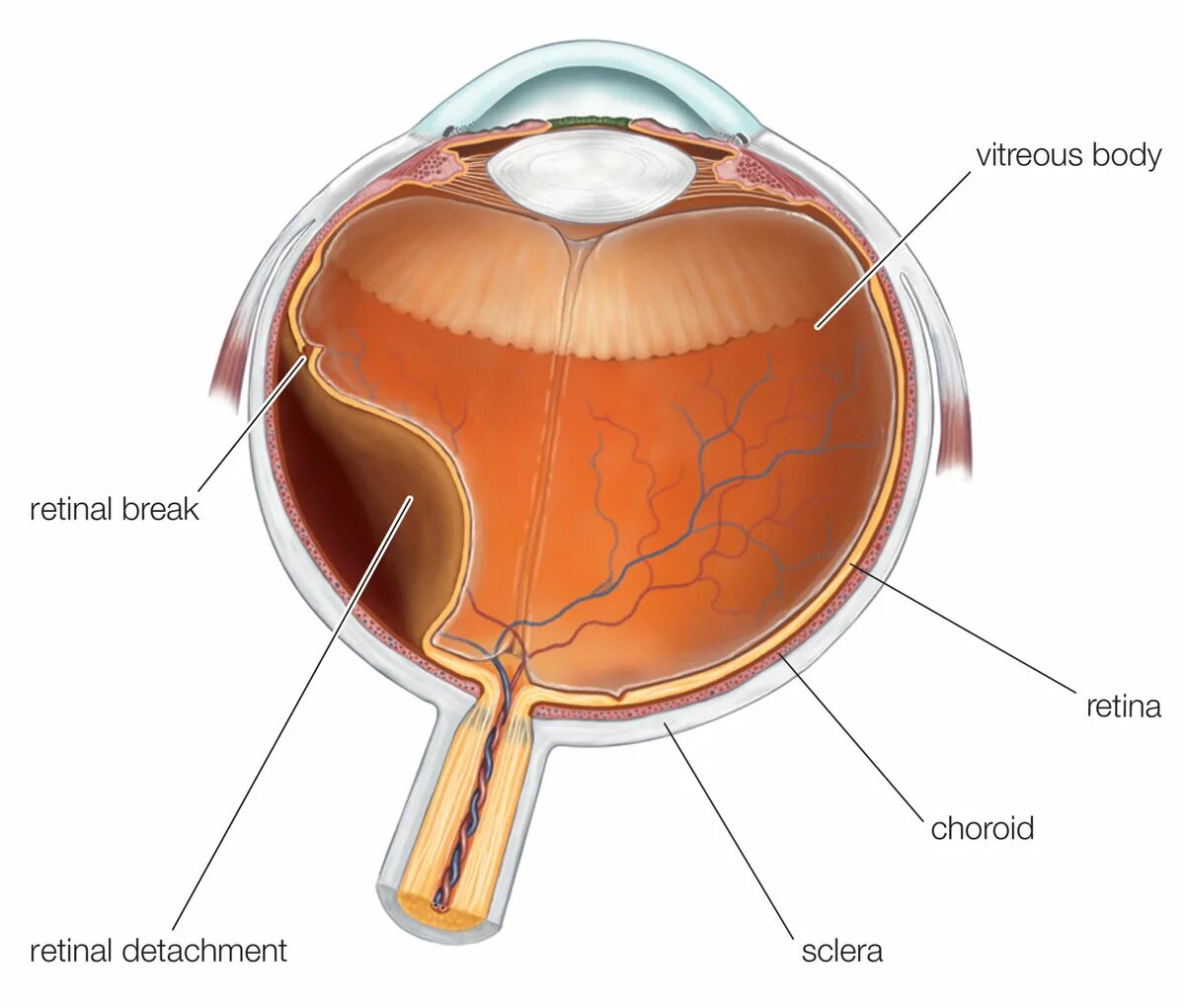 Отслойка сетчатки схема. Сетчатка глаза строение отслоение. Периферическая отслойка сетчатки. Разрыв сетчатки (retinal tear).